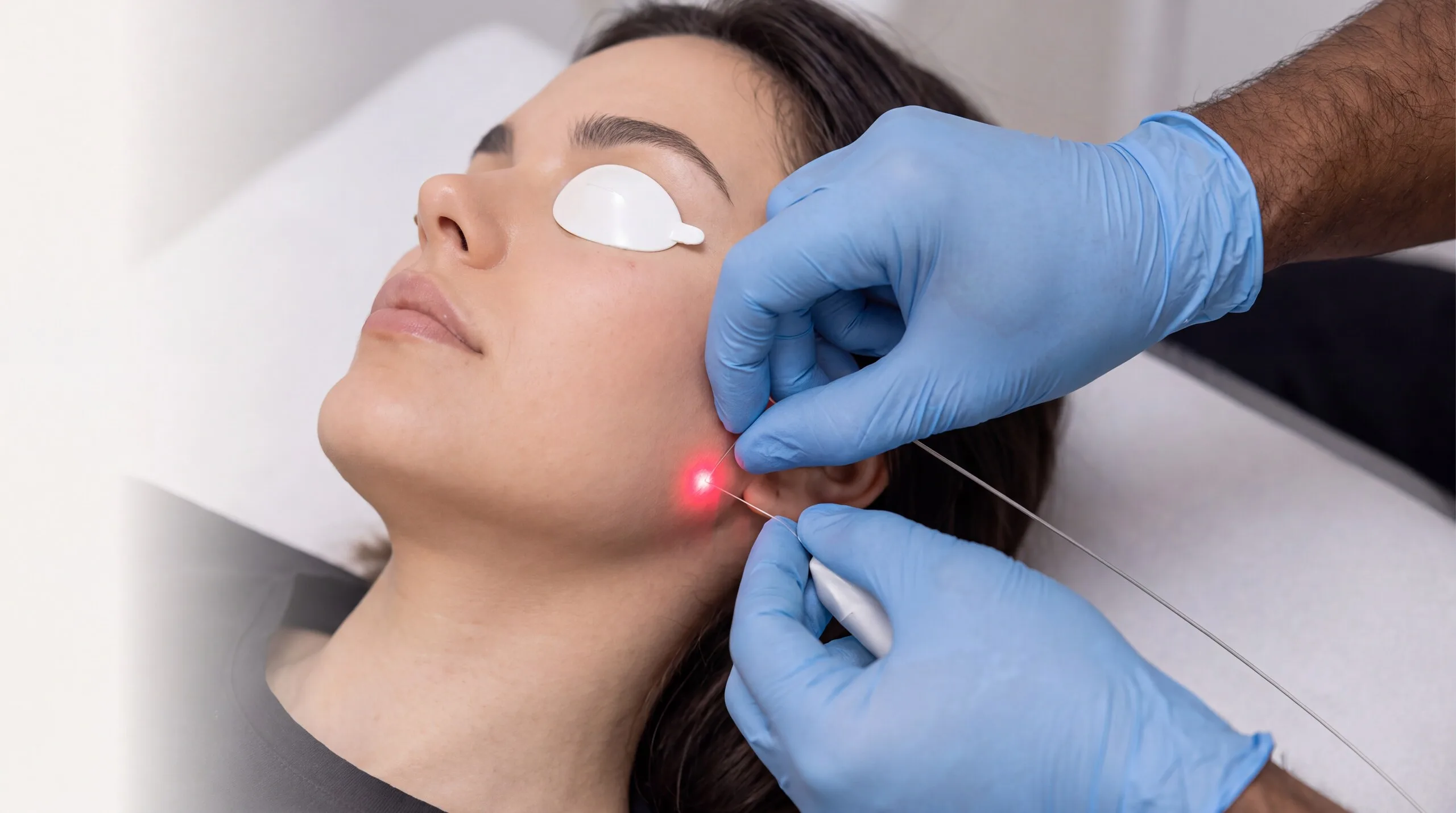 A close view of a woman resting on a treatment couch with a protective cover over one eye while a clinician in blue gloves guides a hair-fine optical fibre to her cheek just in front of the ear, a small red laser point glowing where the fibre meets the skin, during an EndoTight session