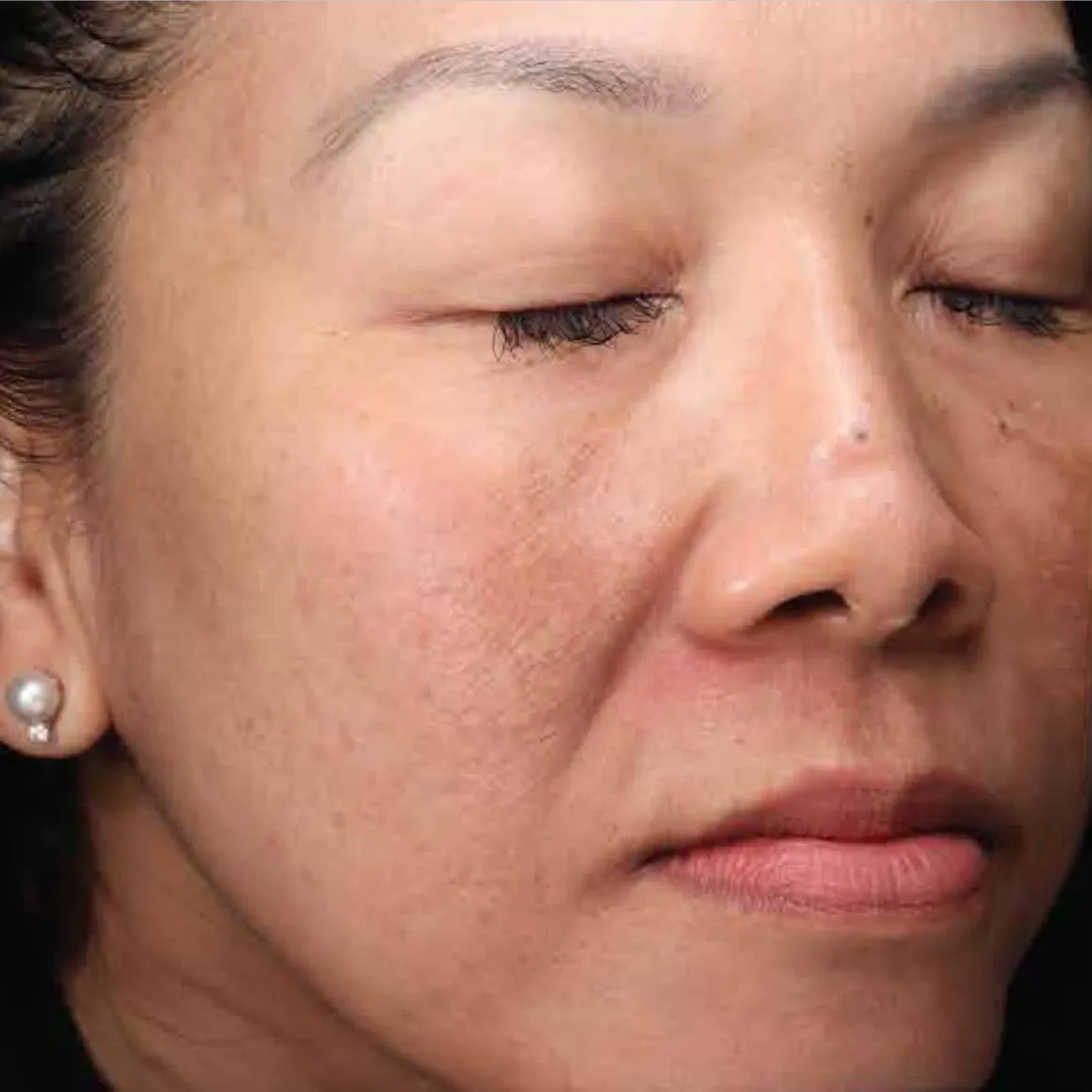 The same three-quarter view after pigment treatment, with the cheek and temple patches lifted and the tone more even