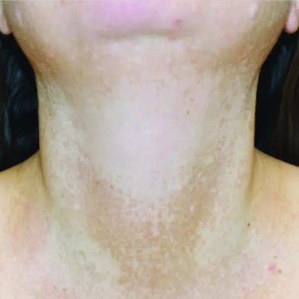 Front view of a woman's neck and upper chest before pigment treatment, showing mottled brown discolouration across the lower neck and collarbones