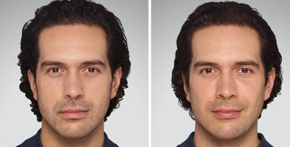 Juvederm before and after, enlarged: the same person before treatment on the left and after treatment on the right, case 2. Results may vary.