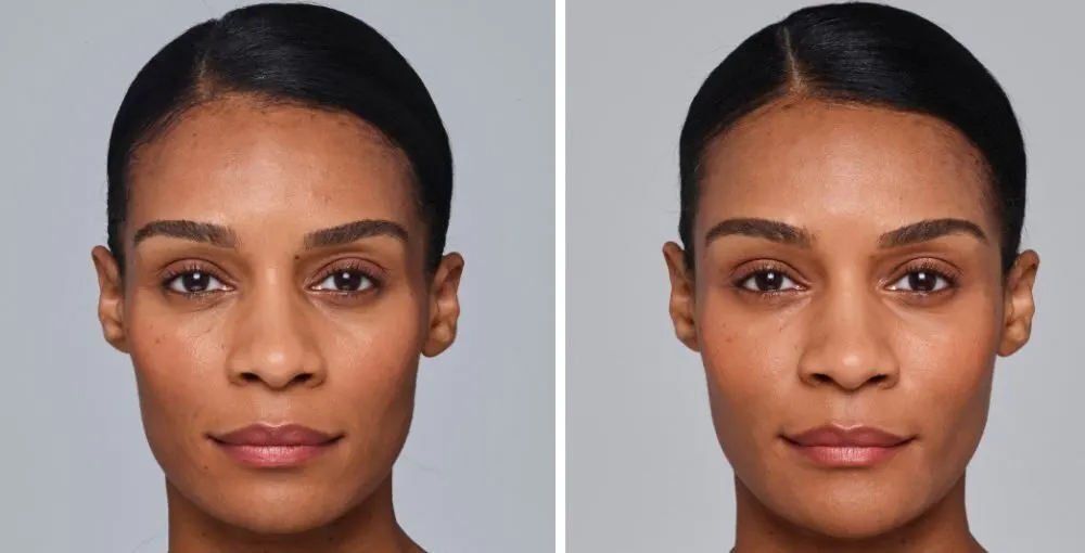 Juvederm before and after: the same person before treatment on the left and after treatment on the right, case 3. Results may vary.