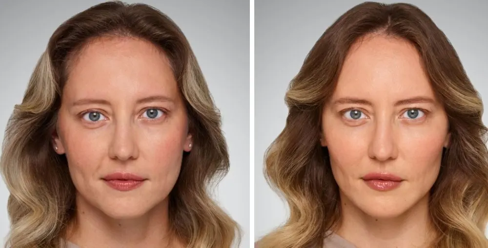 Juvederm before and after: the same person before treatment on the left and after treatment on the right, case 6. Results may vary.