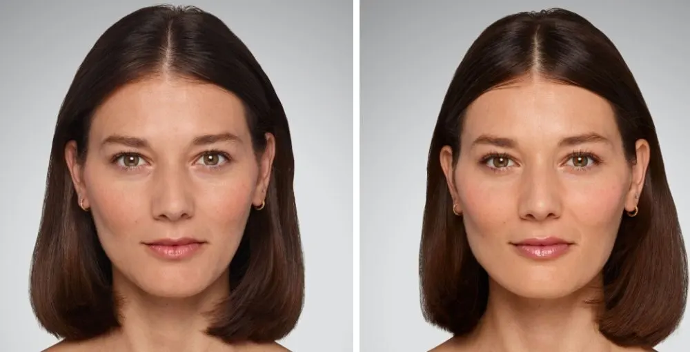 Juvederm before and after: the same person before treatment on the left and after treatment on the right, case 8. Results may vary.