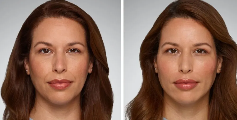Juvederm before and after: the same person before treatment on the left and after treatment on the right, case 10. Results may vary.