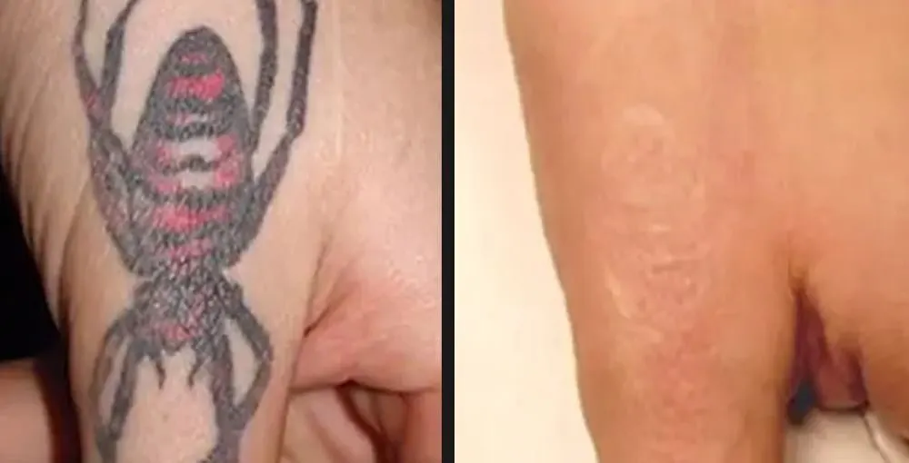 Laser Tattoo Removal before and after: the same person before treatment on the left and after treatment on the right, case 4. Results may vary.