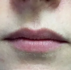 Close front view of a mouth before LipLase, the upper lip narrow and sitting flat above a shallow cupid’s bow