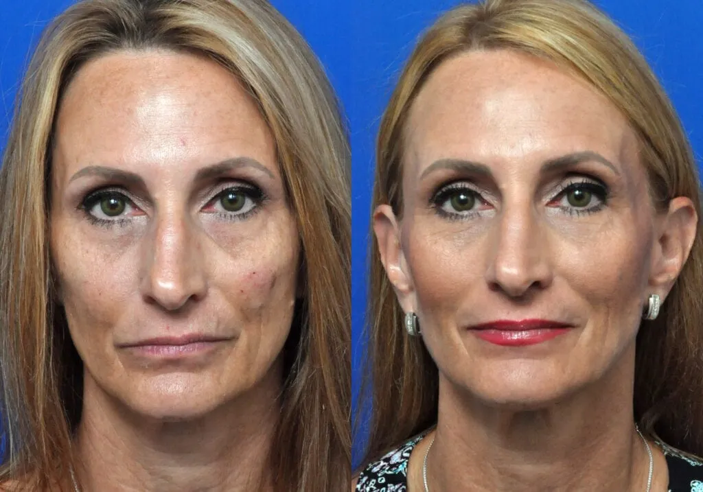 bellafill treatment
