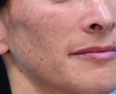 Close-up of a cheek and jaw before Moxi, showing dense freckling and small brown spots over the whole area