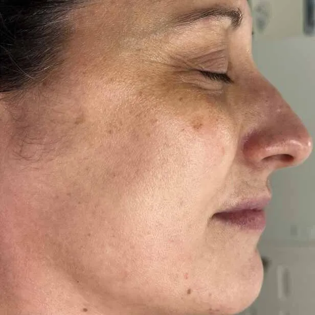 Profile of a woman before Moxi, showing brown sun spots running along the cheek and temple