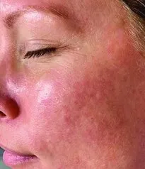 The same three-quarter view after Moxi, with the mottling largely gone and the cheek more even