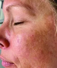 Three-quarter view of a cheek before Moxi, showing heavy brown mottling over a flushed base
