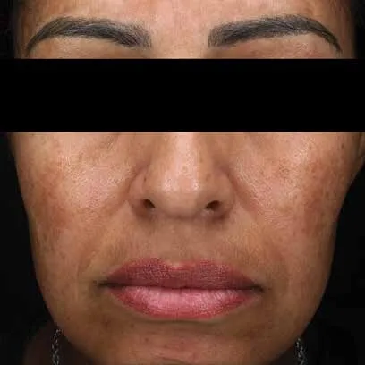 Lower face of a woman before Moxi, showing brown patches across both cheeks and around the mouth