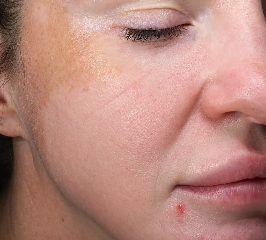 Three-quarter view of a woman before Moxi, showing a run of brown spots gathered at the temple and upper cheek