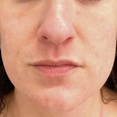 The same lower face after Moxi, with the marks faded and the tone settling out