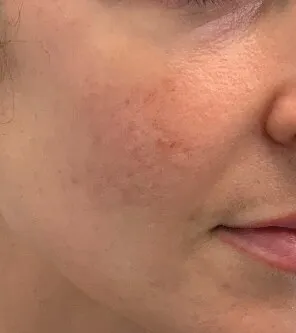 The same cheek after Moxi, with the mottling softened and the tone brighter