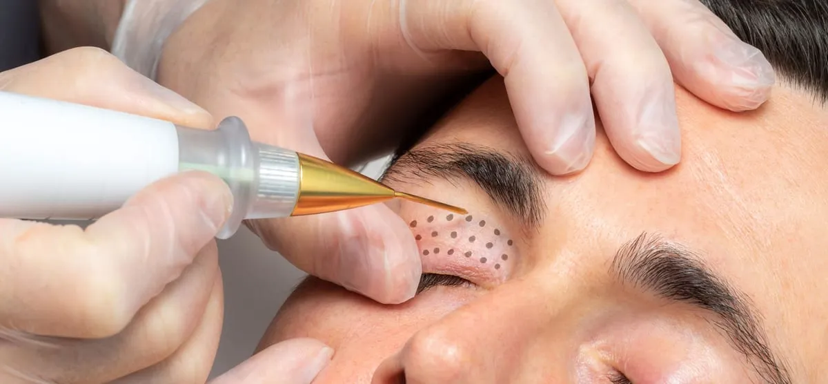 non-surgical blepharoplasty