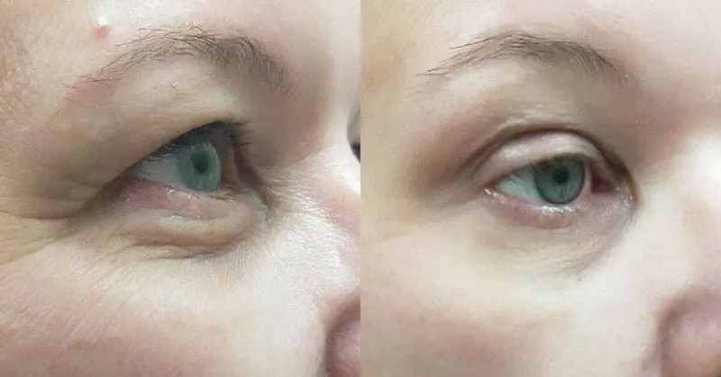 non-surgical blepharoplasty procedure