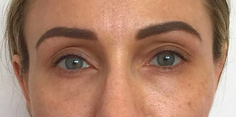 Non-Surgical Blepharoplasty