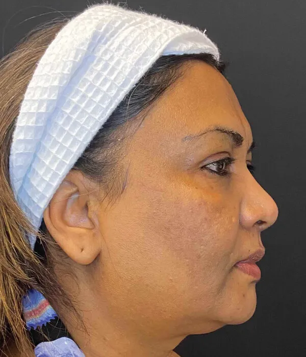 Three-quarter view of the same woman before treatment, showing a broad brown patch over the cheekbone running down towards the jaw