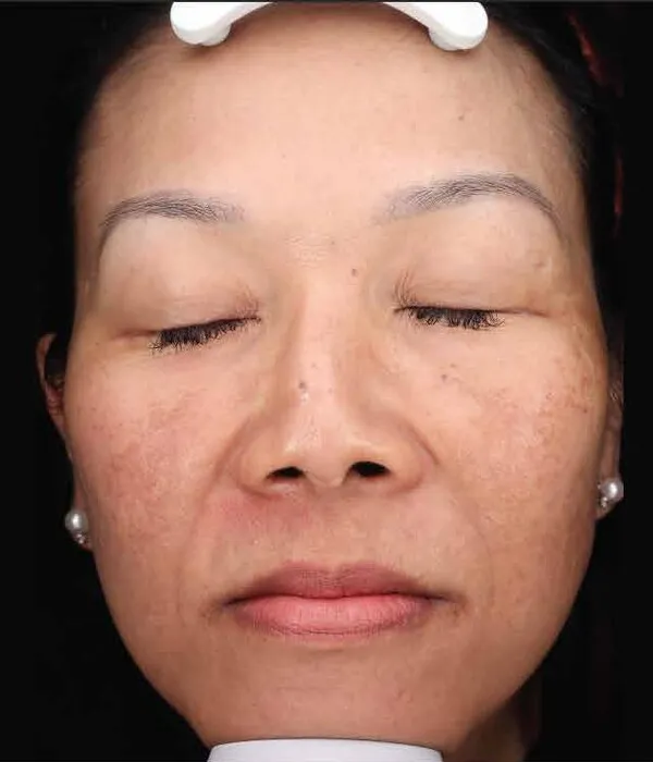 The same front view after treatment, with the pigment across the cheeks lifted and the complexion reading more even