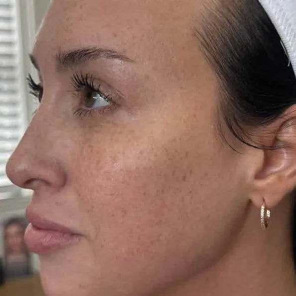 Profile view of the same woman before treatment, showing sun freckling massed across the cheek and running back towards the ear