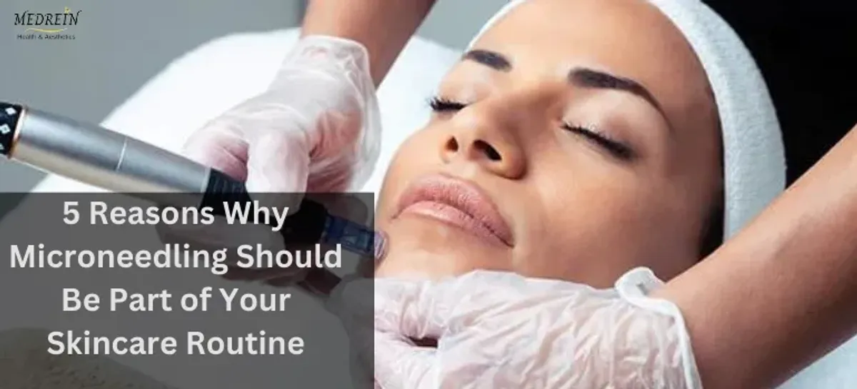5 Reasons Why Microneedling Should Be Part of Your Skincare Routine