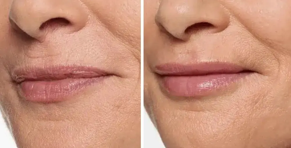 Restylane before and after: the same person before treatment on the left and after treatment on the right, case 1. Results may vary.