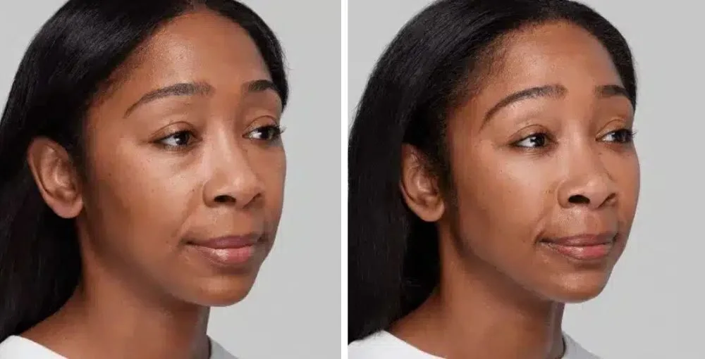 Restylane before and after, enlarged: the same person before treatment on the left and after treatment on the right, case 2. Results may vary.