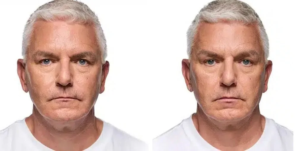 Revanesse (Versa) before and after, enlarged: the same person before treatment on the left and after treatment on the right, case 1. Results may vary.