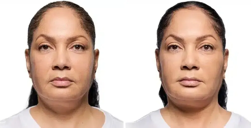 Revanesse (Versa) before and after: the same person before treatment on the left and after treatment on the right, case 3. Results may vary.