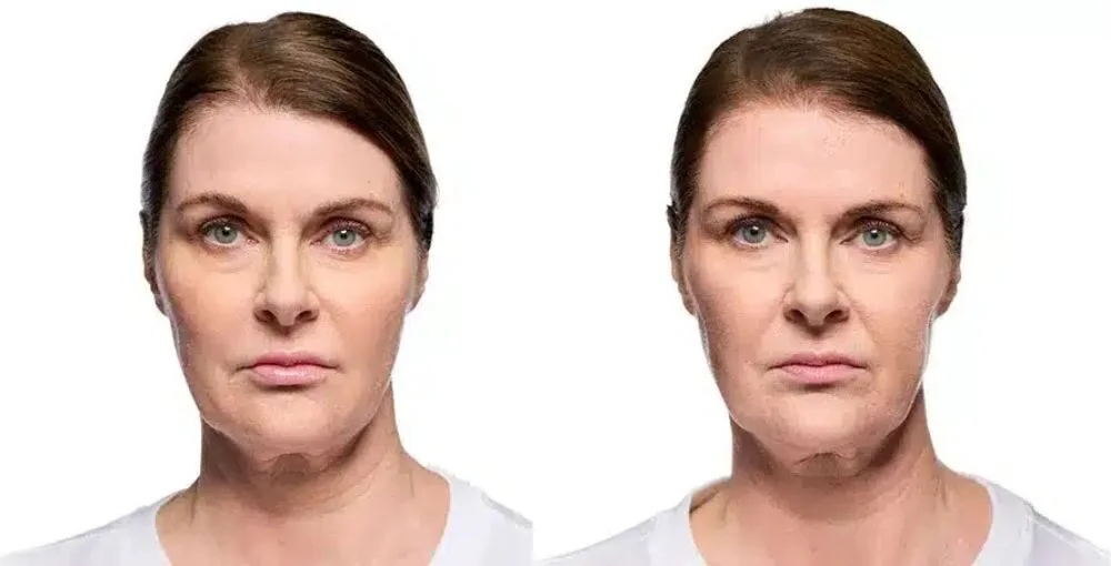 Revanesse (Versa) before and after, enlarged: the same person before treatment on the left and after treatment on the right, case 4. Results may vary.