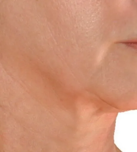The same jaw and neck after RF microneedling, with the neck lines much finer and the jawline reading more defined