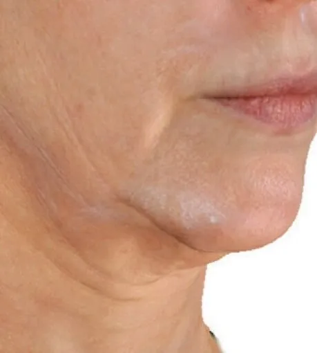 Three-quarter view of a woman’s jaw and neck before RF microneedling, showing crepey horizontal lines down the neck and a jawline losing its edge
