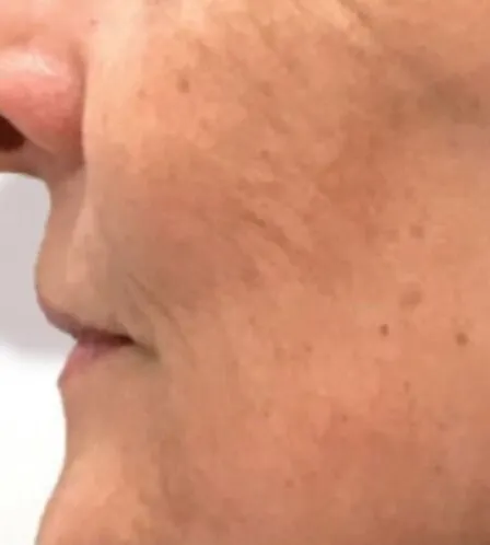 A near-profile of the same lower face after RF microneedling, with the cheek lines shallower and the flushing settled