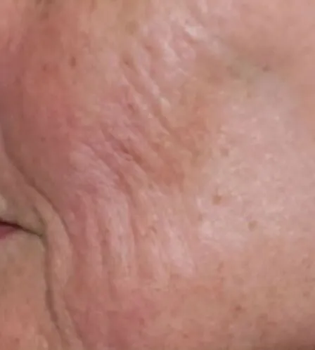Close view of a woman’s cheek before RF microneedling, showing dense fine lines fanning across the cheek over flushed skin