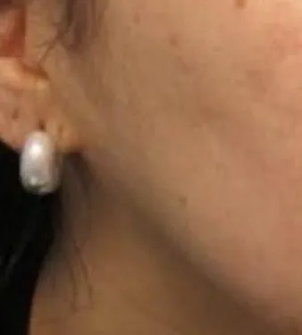 A view of the same face after RF microneedling, with the cheek reading smooth and the pitting no longer catching the light