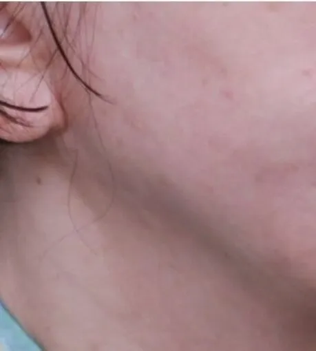 A view of the same face after RF microneedling, with the skin along the jaw clear and evenly toned