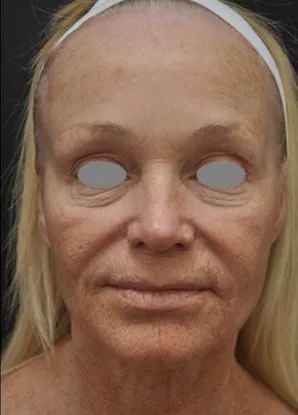 Front view of a woman before laser resurfacing, showing mottled sun damage across the cheeks, lines around the mouth and loose skin on the neck