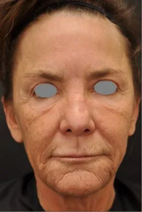 Front view of a woman before laser resurfacing, showing deep folds down both cheeks and heavily sun-worn texture