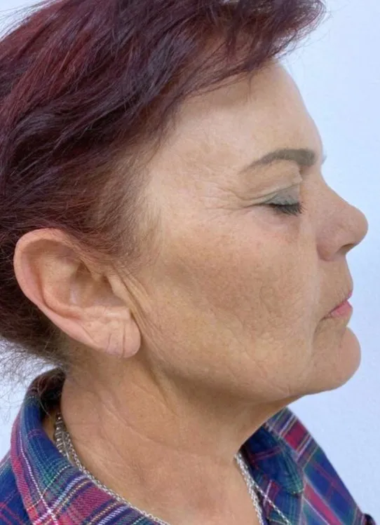 The same three-quarter view after laser resurfacing, with the mottling cleared and the jawline smoother