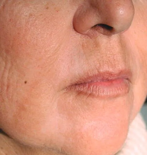 The same close-up after laser resurfacing, with the lip lines softened and the chin smoother