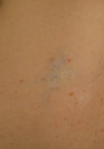 The same lower back after laser tattoo removal, with only a faint bluish shadow where the butterfly was