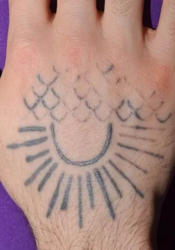Back of a hand before laser tattoo removal, showing a solid black sunburst with a band of scalework