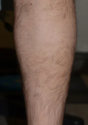 The same calf after laser tattoo removal, with the script gone and the skin clear