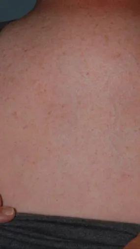 The same upper back after laser tattoo removal, with the symbol cleared