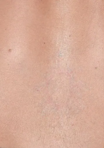The same lower back after laser tattoo removal, with only a faint red-grey shadow left