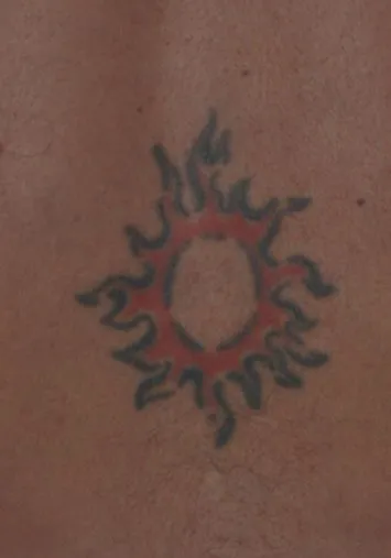 Lower back before laser tattoo removal, showing a black tribal sun with red infill