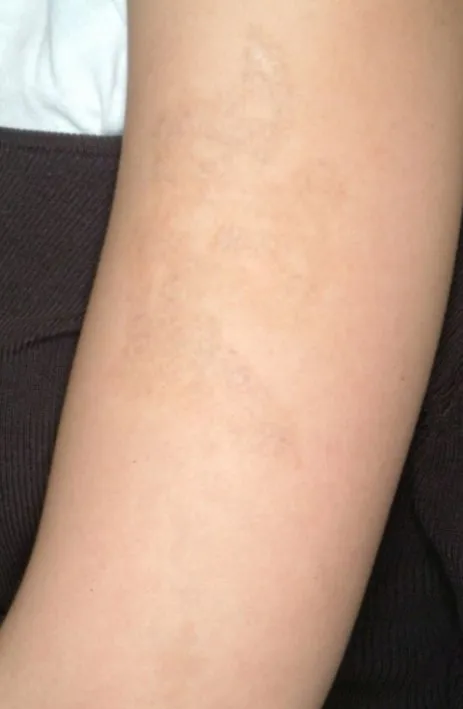 The same inner upper arm after laser tattoo removal, with the outline gone