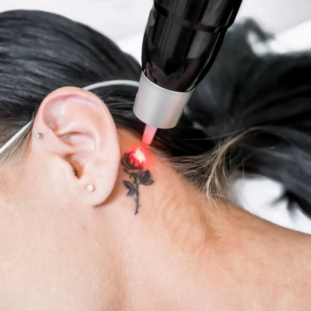 Laser handpiece treating a small tattoo behind a woman's ear, with a red aiming beam on the skin