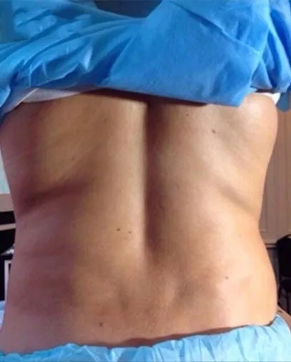 Back view of a woman before TightSculpting, showing soft rolls across the lower back and both flanks